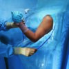 Halyard Sterile Shoulder Arthroscopy Orthopedic Drape